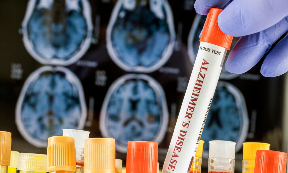 Organoidi cerebrali per la ricerca sulla malattia di Alzheimer
