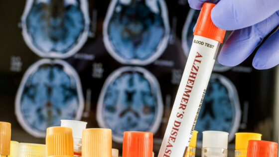 Organoidi cerebrali per la ricerca sulla malattia di Alzheimer